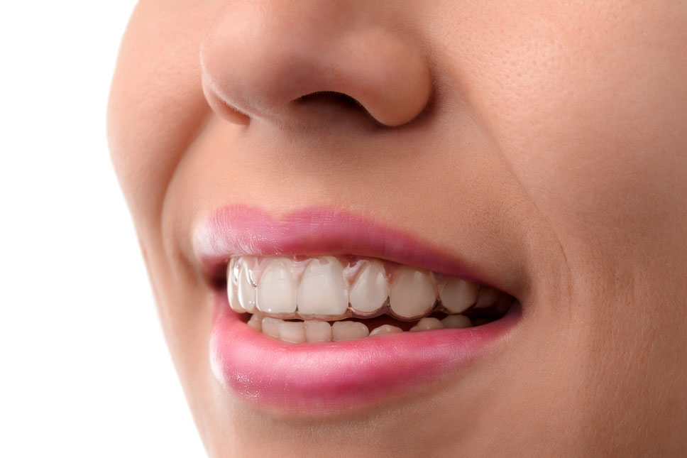 Invisalign2