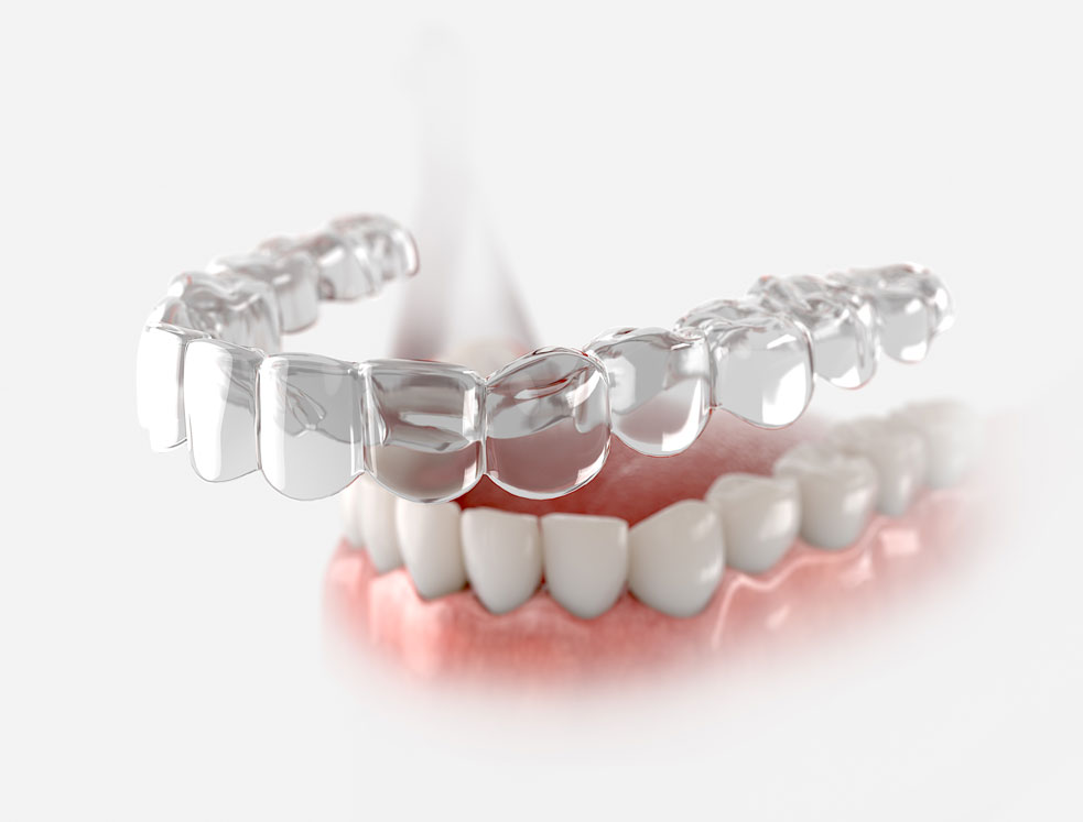 Invisalign4 Invisalign4